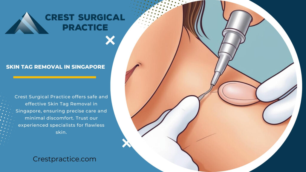 Say Goodbye to Skin Tags: Safe and Effective Removal Options in Singapore